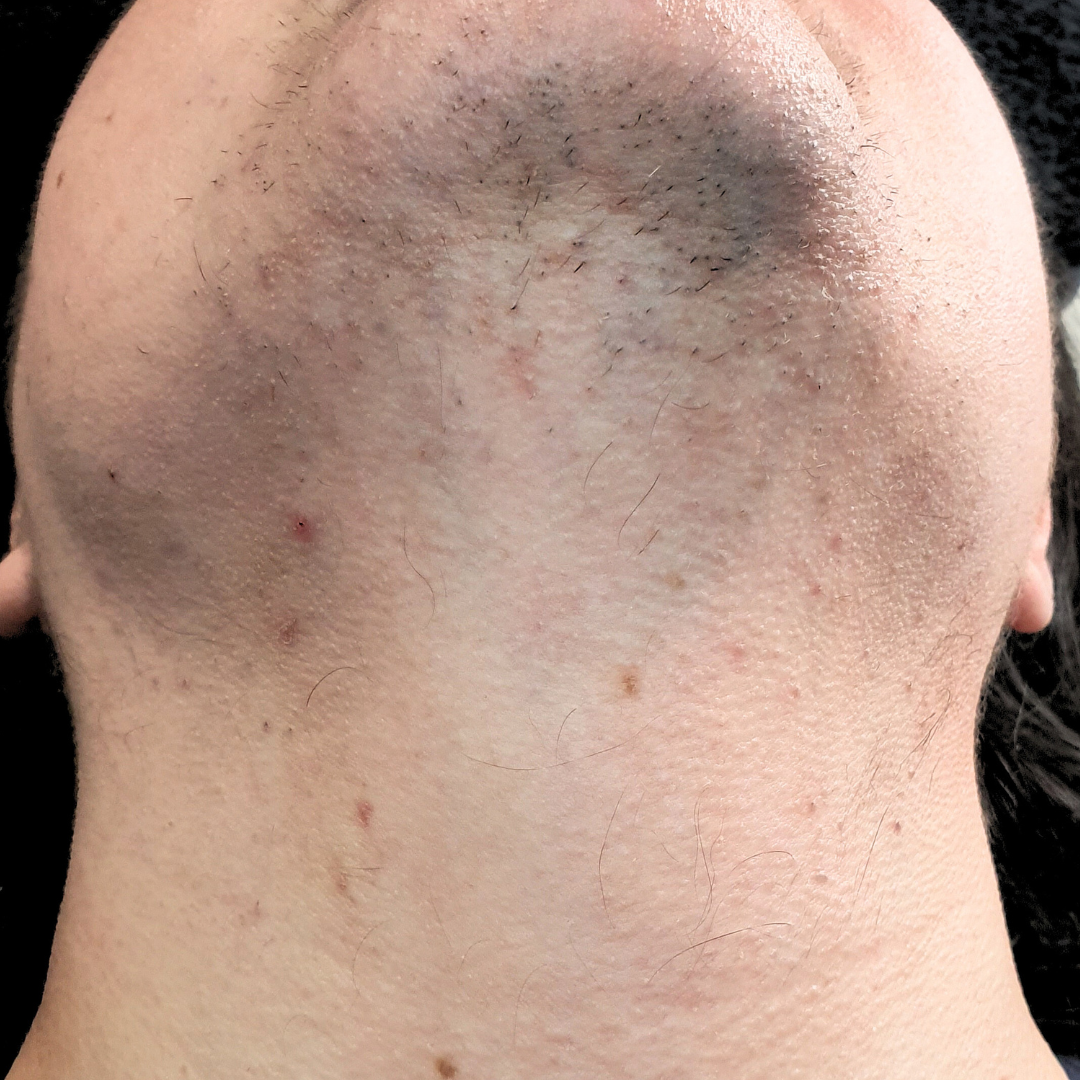 Avant épilation définitive laser médical - Menton / cou