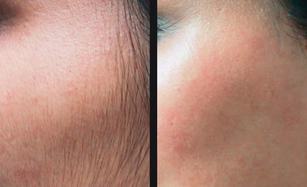 Résultat épilation définitive laser médical - Visage