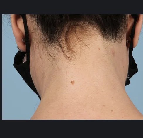 Après épilation définitive laser médical - Cou / nuque