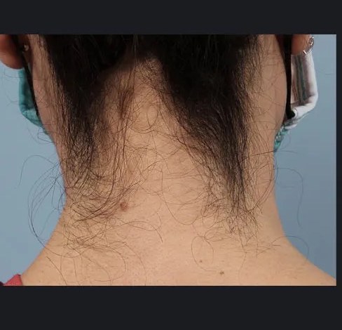 Avant épilation définitive laser médical - Cou / nuque